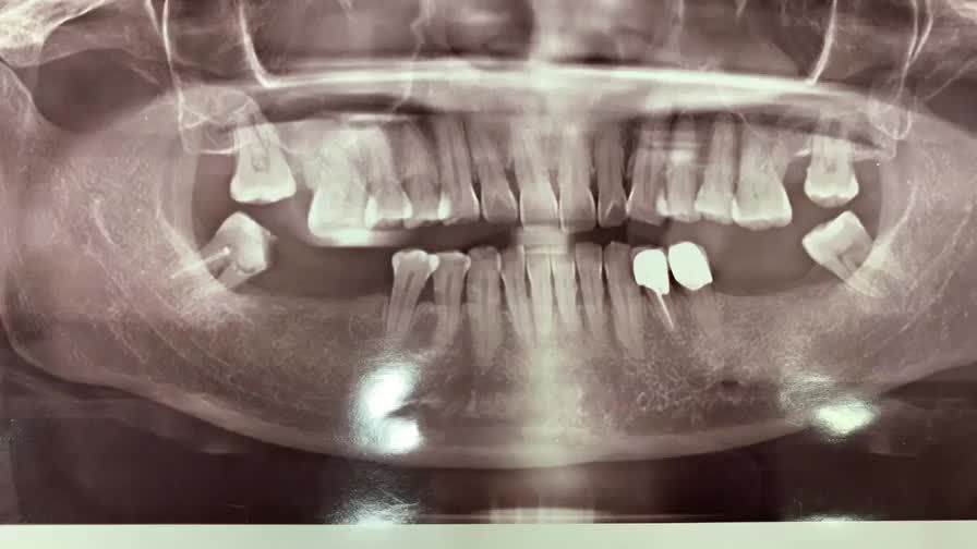 Ca lắp răng implant phục hình răng 36, 46 bị mất cho cô khách hàng tại Nha Khoa Thuỳ Anh.
